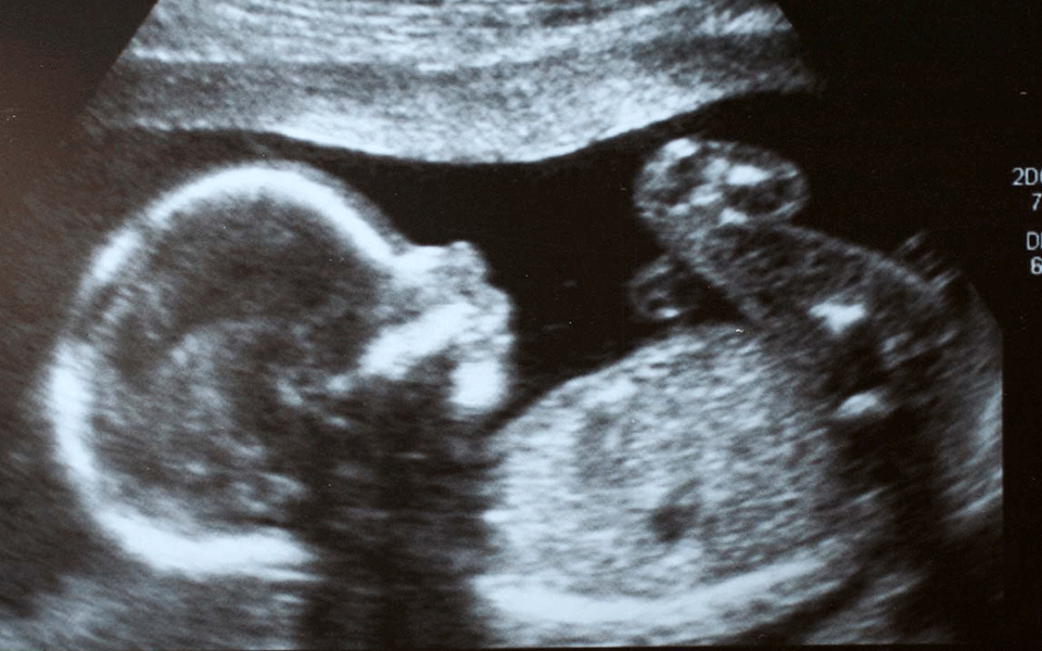 Eight fetuses found in 21-day-old baby